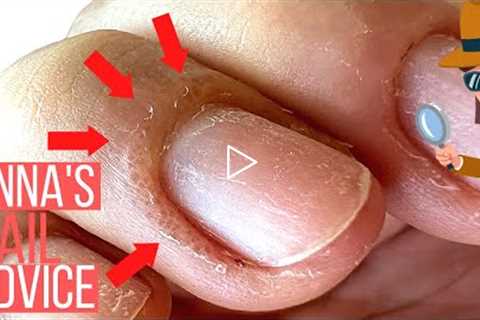 THINKING ABOUT GEL POLISH? YOU NEED TO KNOW WHY THIS HAPPENS [ALLERGIC REACTIONS & OVEREXPOSURE]