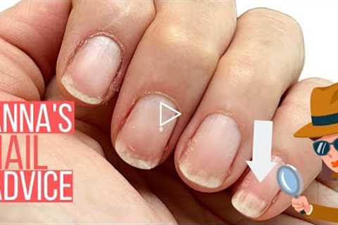 WHITE PATCHES ON NAILS? ANNA HELP! [ANNA'S NAIL ADVICE]