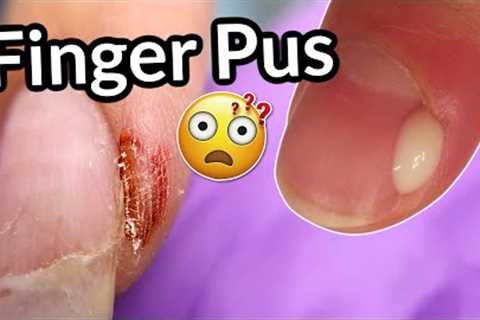 Infected Finger After Nail Salon 😱 WHY did it happen? | Paronychia