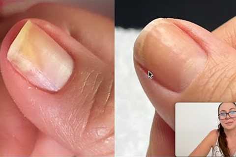 How she regrew her separated nail. [Onycholysis]