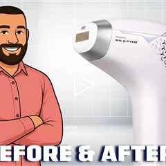DermRays Diode Laser Hair Removal 6 Months Later!