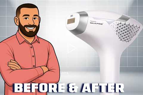 DermRays Diode Laser Hair Removal 6 Months Later!